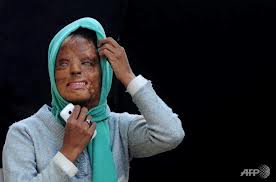 http://www.hinduhumanrights.info/wp-content/uploads/2012/12/acid-attack-victim-Sonali-Mukherjee-spurned-the-advances-of-three-of-her-fellow-students-they-responded-by-melting-her-face-with-acid..jpeg